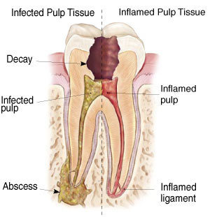 endodontic diagram of an infected tooth