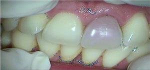 tooth ready to undergo internal bleaching at Malvern Endodontics