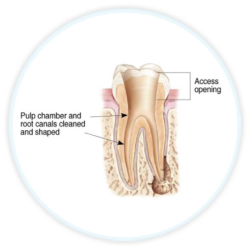 endodontic diagram showing open canals