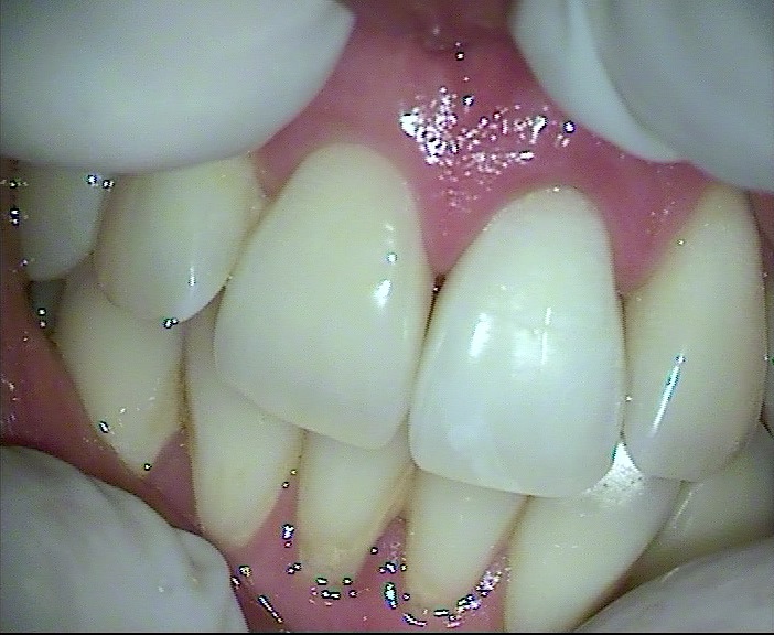 a healthy tooth post-internal bleaching at Malvern Endodontics