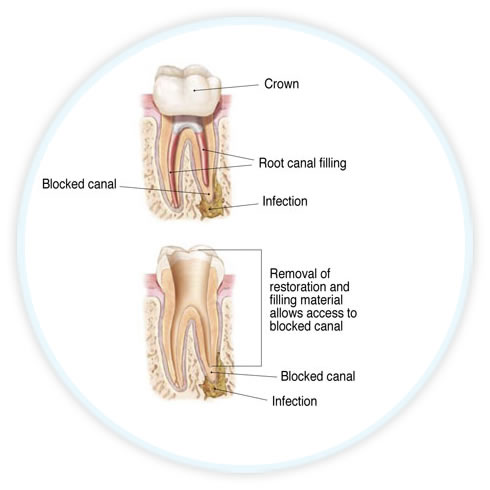 endodontic diagram showing retreatment