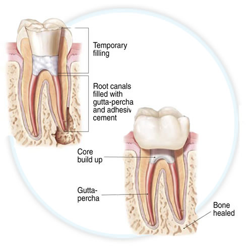 endodontic diagram showing temporary crown